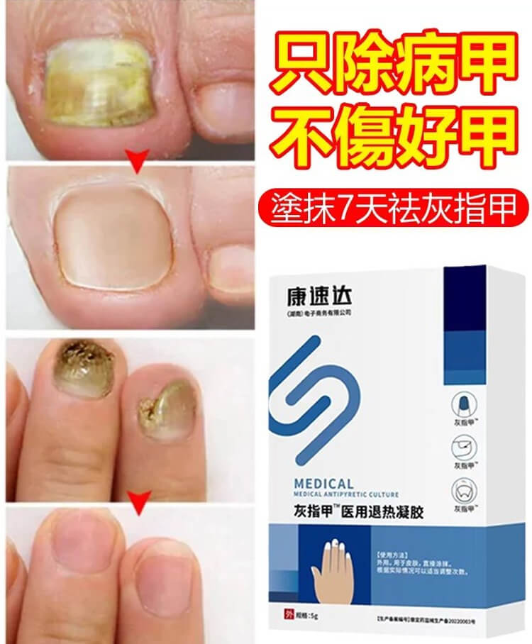 c996330dbfd979987dcb4e444495019a 康速達灰指甲醫用退熱凝膠